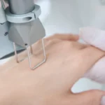 wratten-behandeling